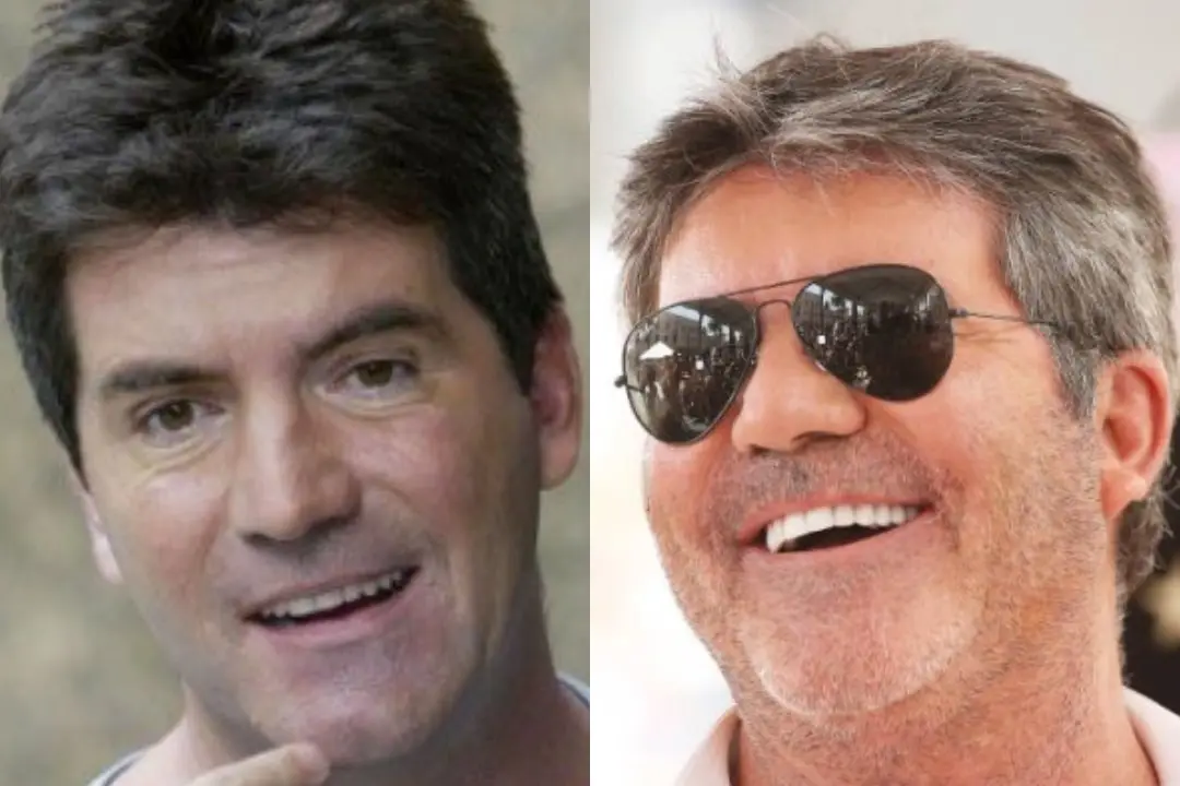 Simon Cowell teeth before and after