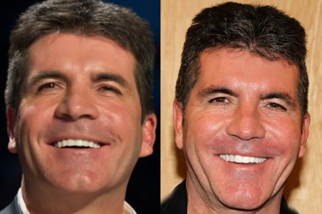 Simon Cowell teeth before and after