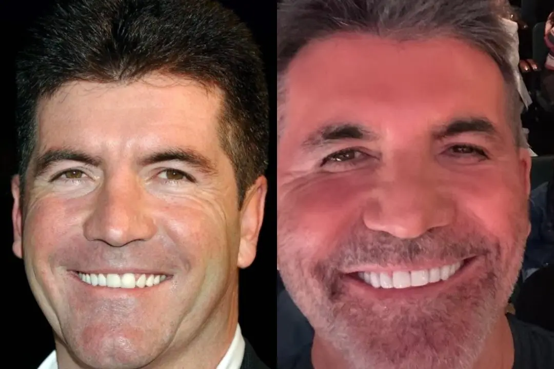 Simon Cowell teeth before and after