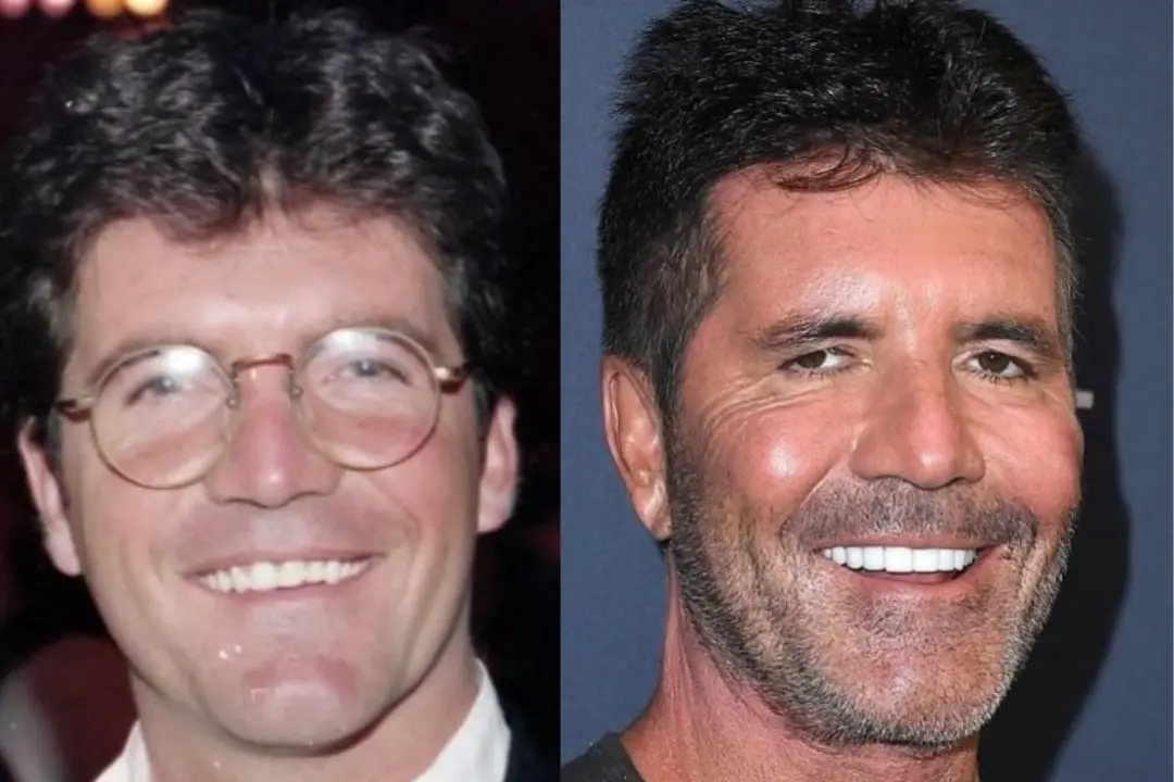 Simon Cowell veneers before after Simon Cowell veneers teeth before after