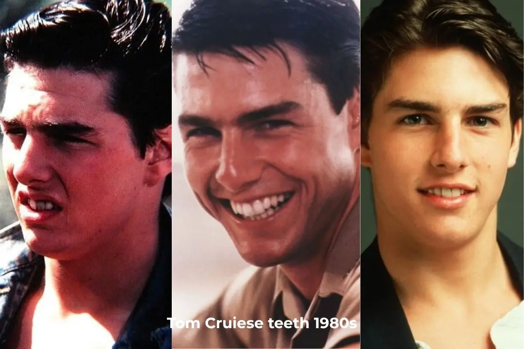 Tom Cruise's teeth before after in the 1980s