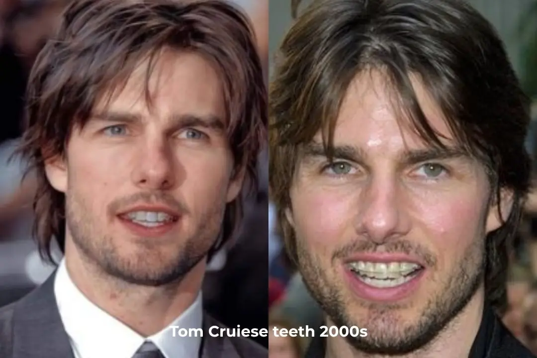 Tom Cruise's teeth before and after in the 2000s