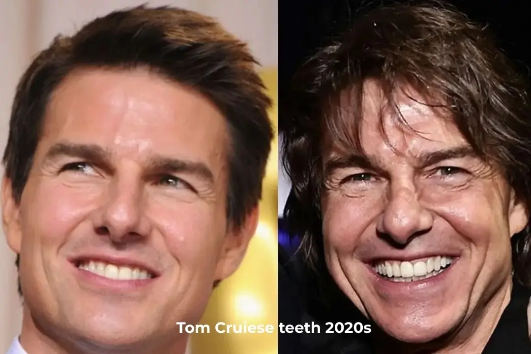 Tom Cruise's teeth before and after in the 2020s