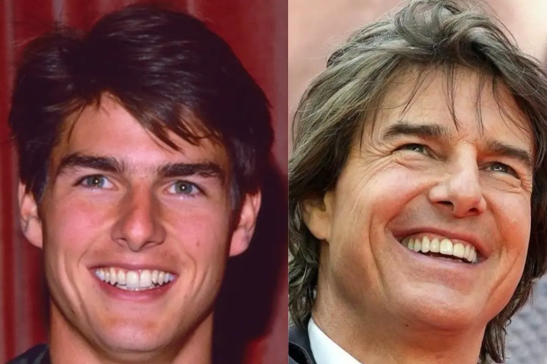 Tom Cruise dental veneers before after