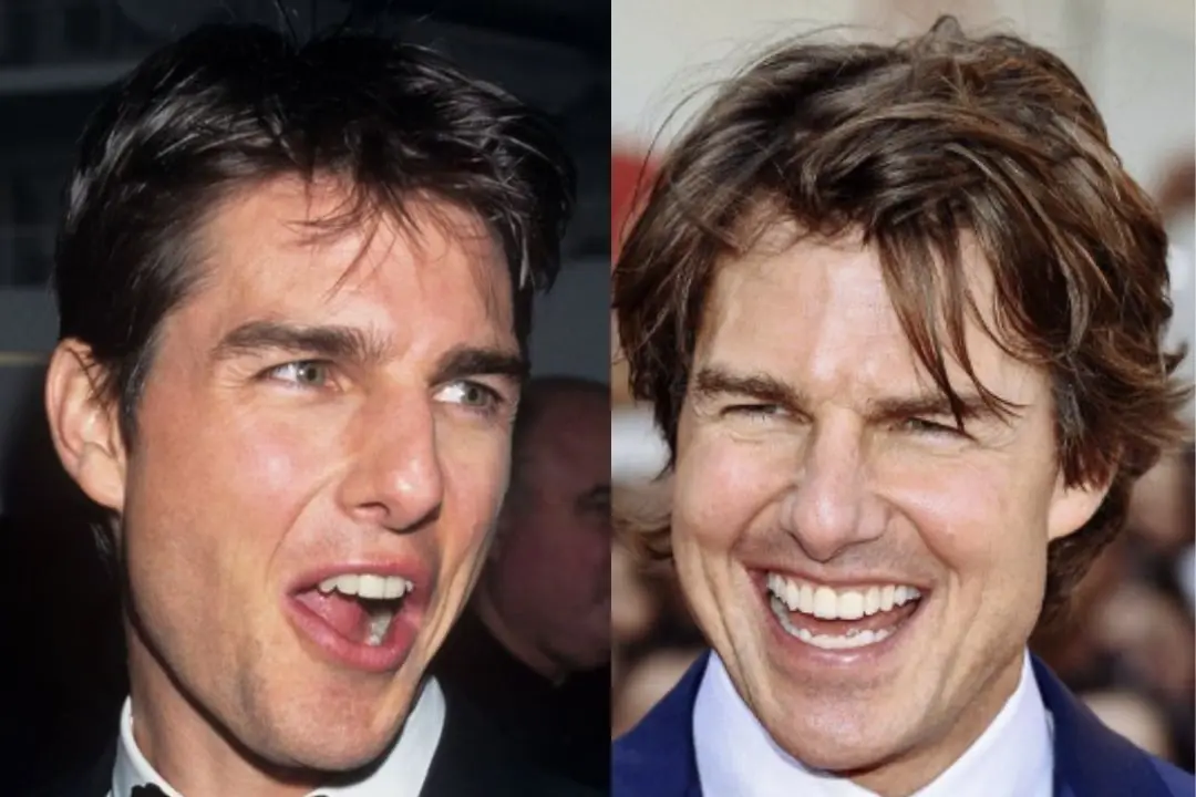 Tom Cruise teeth before after