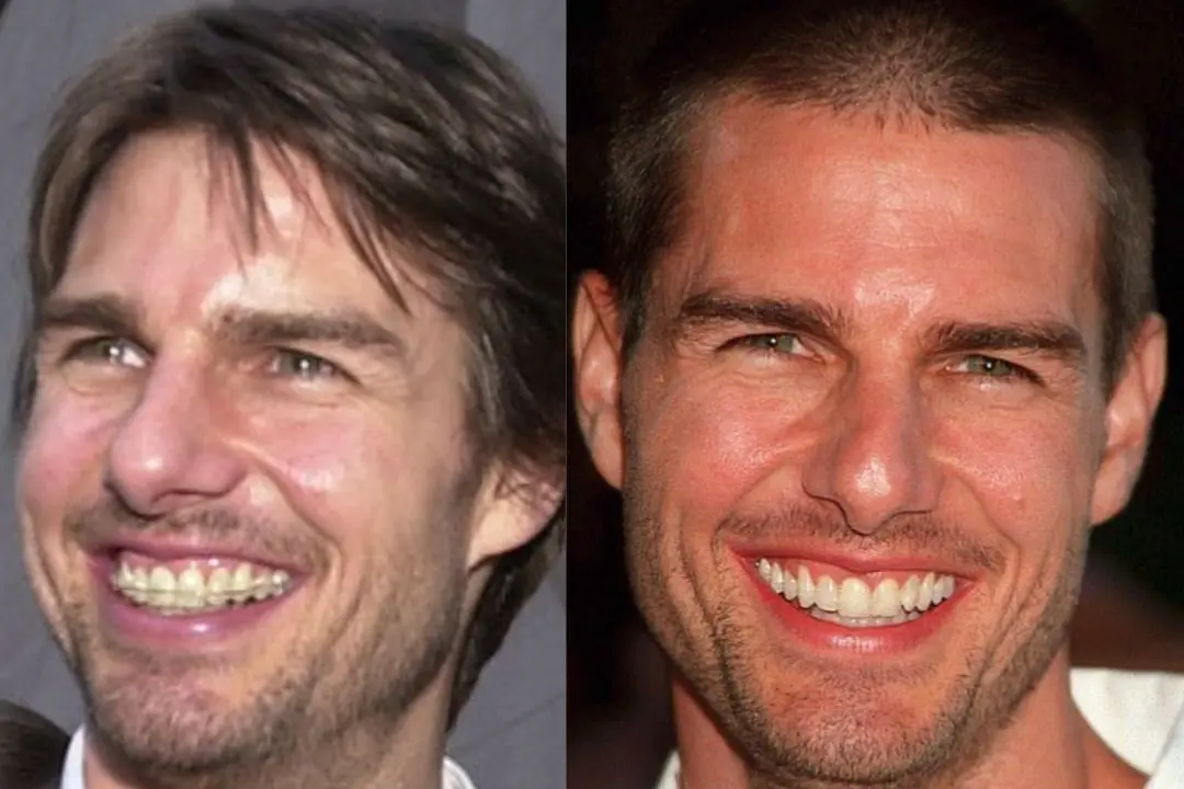 Tom Cruise braces