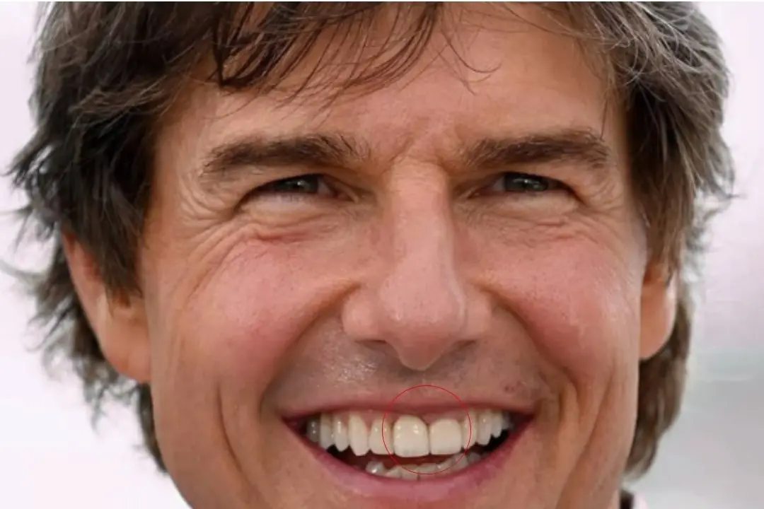 Tom Cruise 3 front teeth