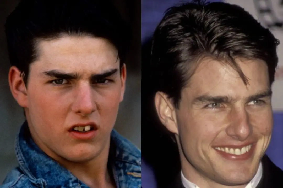 Tom Cruise young teeth