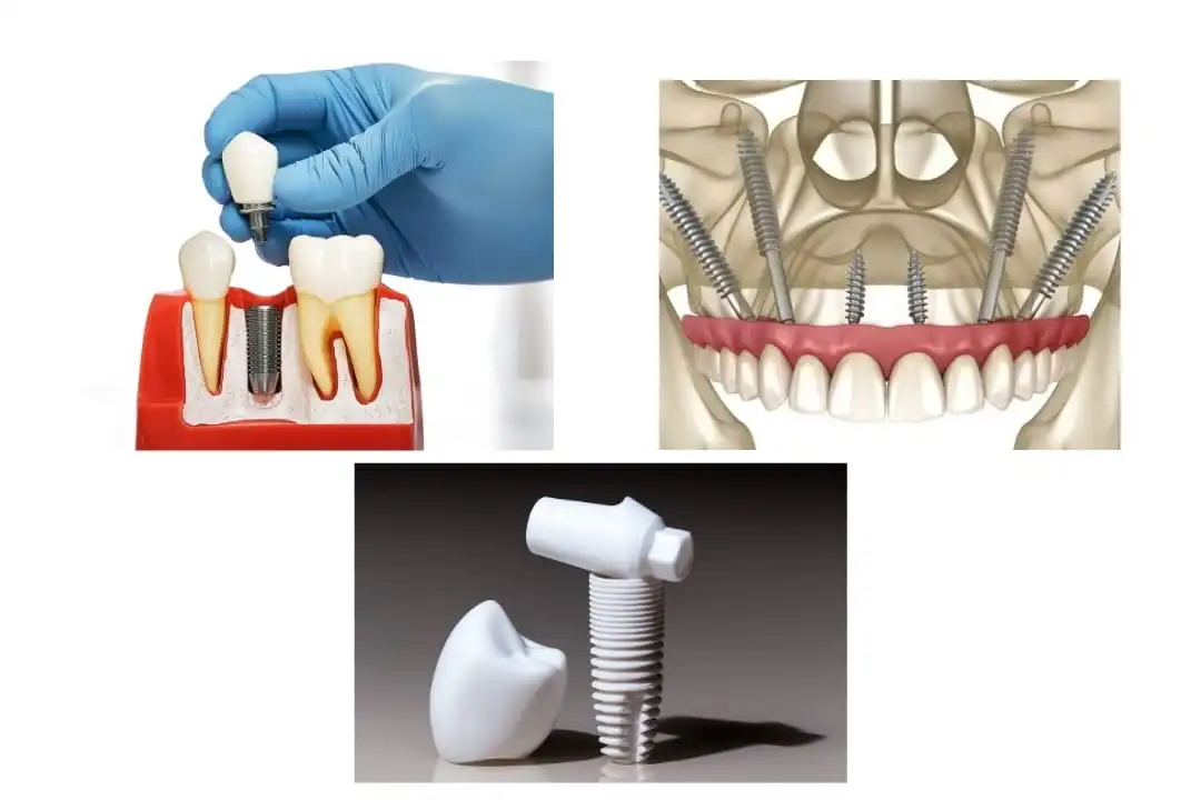 Which type of implant is best for me?