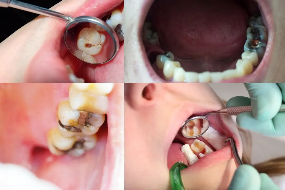 What should you do if your filling hurts after months? What should you do if your filling hurts after months?