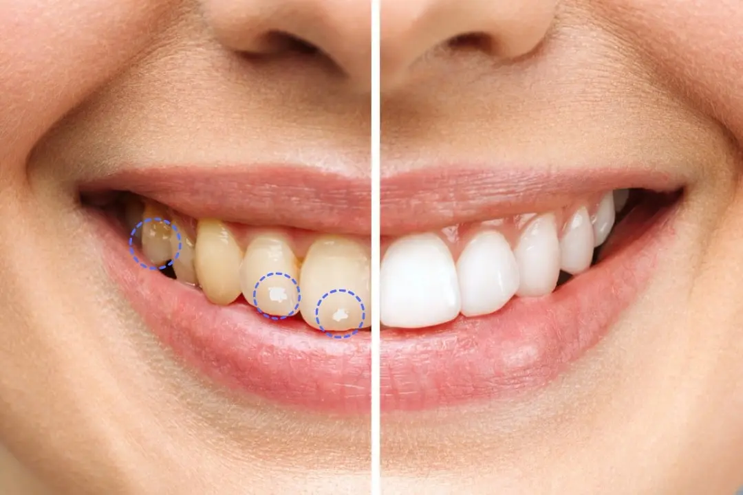 About treatment options for white spots on teeth About treatment options for white spots on teeth