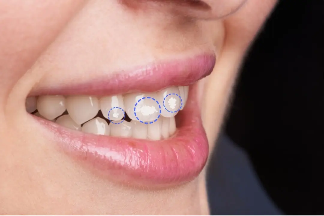 White marks on teeth