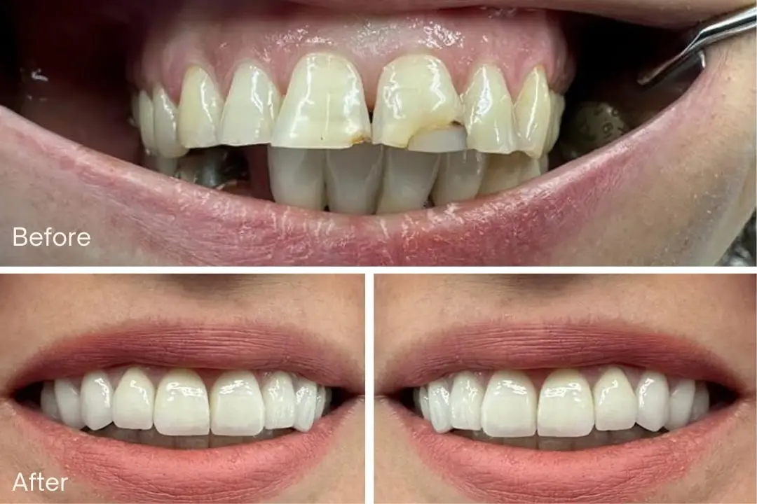 Zirconia Crowns in Turkey