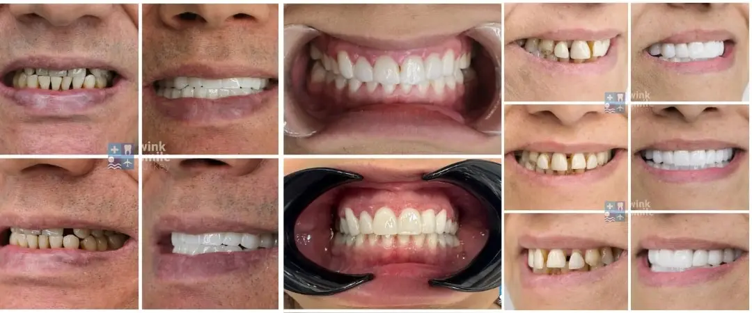 Zirconia Crowns before after Zirconia Crowns before after Turkey