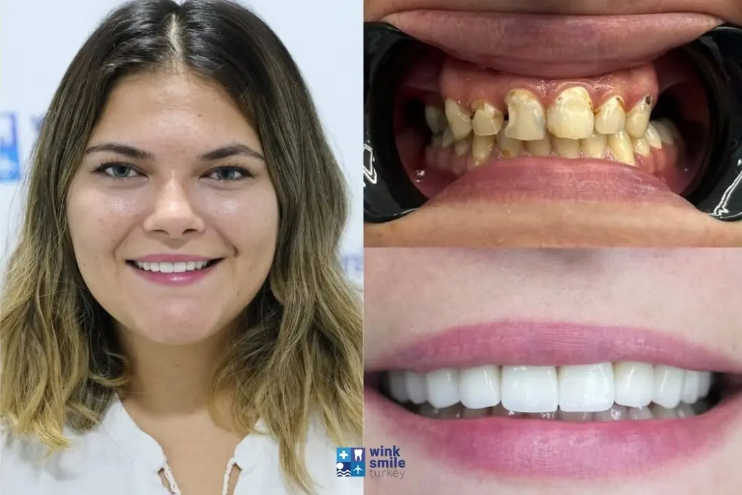 Zirconium crowns before after Antalya & Turkey