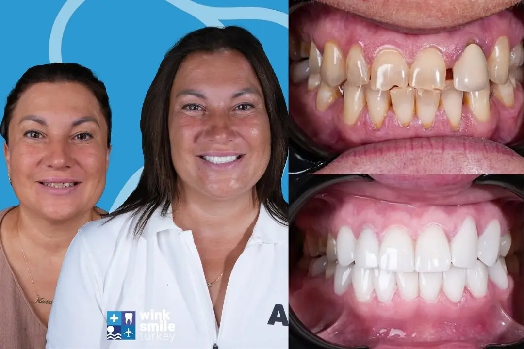 Zirconium crowns before after Antalya & Turkey