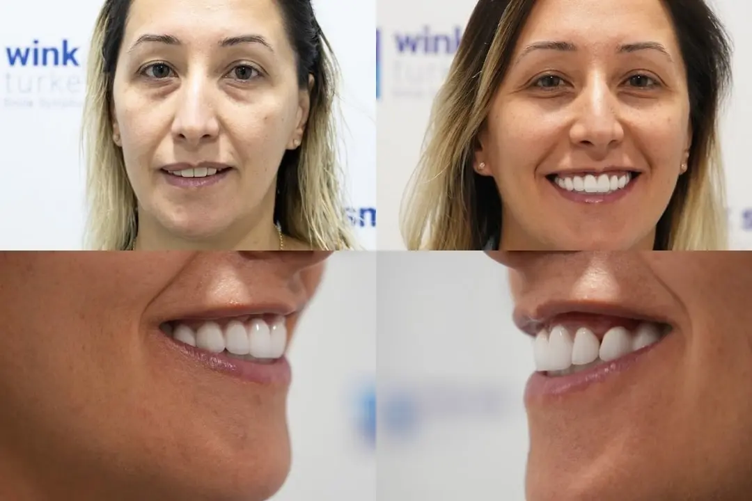 Zirconium crowns before after Antalya