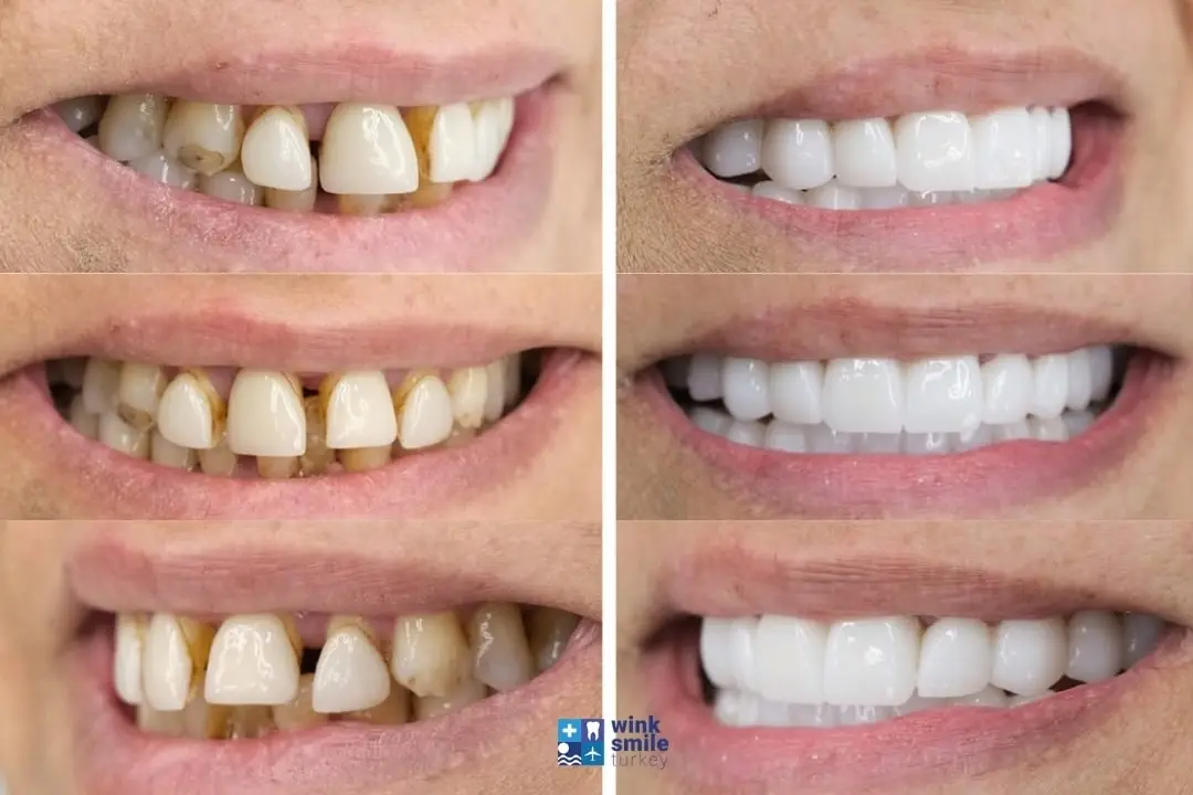 Zirconium crowns before after Turkey