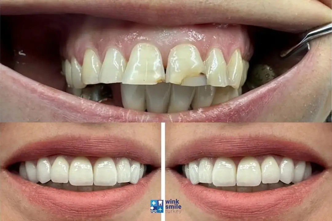 Zirconium crowns before after Turkey