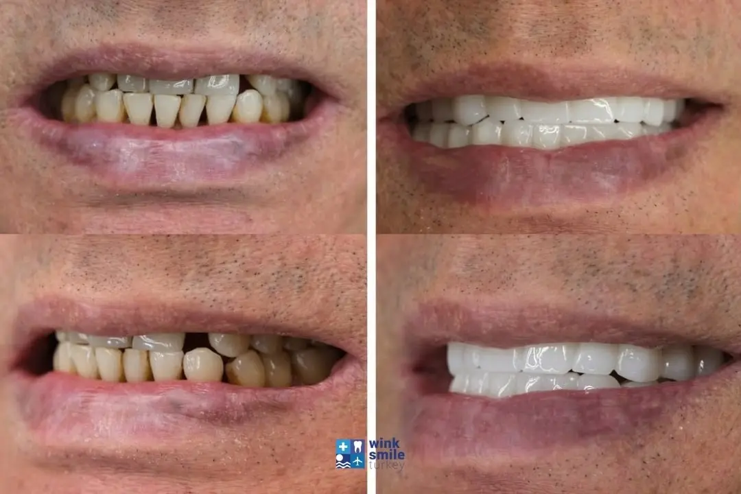 Zirconium crowns before after Antalya & Turkey
